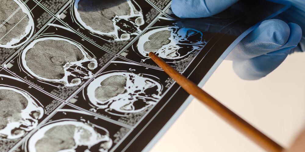 Quando procurar um neurocirurgião